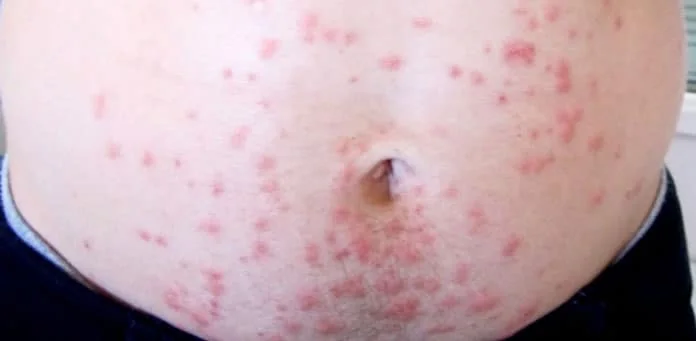 Sea lice in Cancun